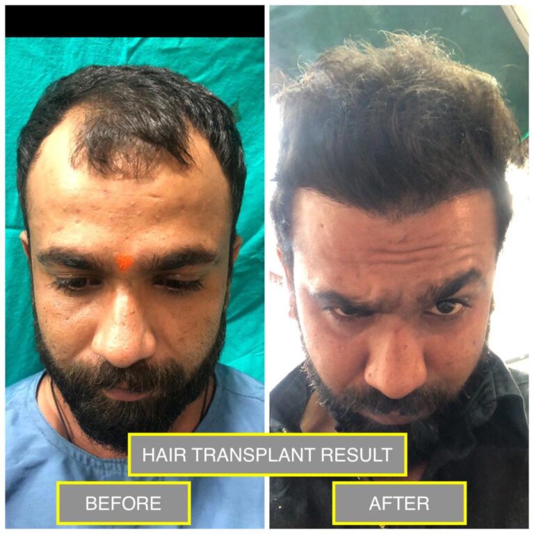 Best Hair Transplant in Bhopal - Aashraya Clinic